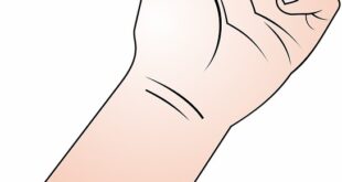 تعرف على علاج الإصبع الزناد طبيعياً.بقلم: د. إيمان بشير ابوكبدة|| موقع مقال